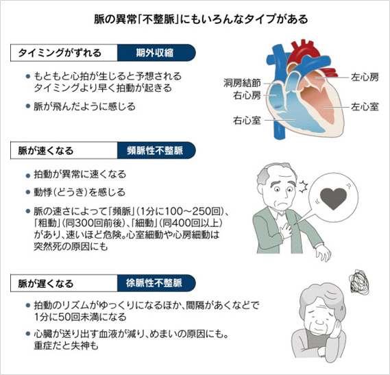 脈の異常「不整脈」にもいろんなタイプがある　タイミングがずれる「期外収縮」　もともと心拍が生じると予想されるタイミングより早く拍動が起き、脈が飛んだように感じる。　脈が速くなる「頻脈性不整脈」　拍動が異常に早くなり動悸を感じる。脈の速さによって頻脈（1分に100から250回）、粗動（同300回前後）、細動（同400回以上）があり、速いほど危険。心室細動や心房細動は突然死の原因にも　脈が遅くなる「徐脈性不整脈」　拍動のリズムがゆっくりになるほか、間隔があくなどで1分に50回未満になる。心臓が送り出す血液が減り、めまいの原因にも。重症だと失神も。